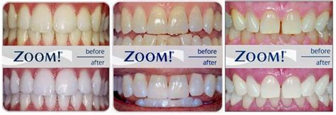 Top 3 Reasons To Whiten With ZOOM!