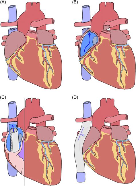 Surgical repair of tricuspid atresia. A, Bidirectional Glenn procedure ...