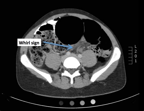 Emergency Medicine Visual Diagnosis: Diagnosis: Sigmoid Volvulus