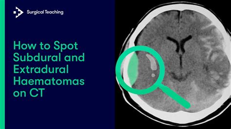 Extradural vs Subdural Haematomas | How do we Diagnose them on CT? - YouTube