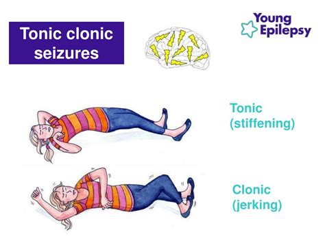 PPT - KS3 Epilepsy awareness & first aid lesson PowerPoint Presentation - ID:5559642