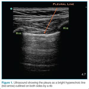 Emergency Ultrasound: Pneumothorax Assessment | MDedge Emergency Medicine