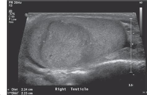 Figure 1 from Testicular Tumor Ultrasound Characteristics and Association with Histopathology ...