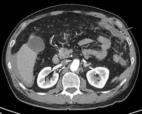 Cureus | Delayed Splenic Rupture Resulting in Massive Intraperitoneal ...