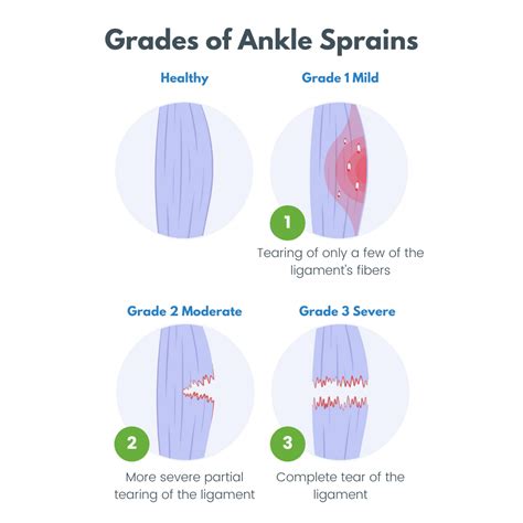 Ankle Sprain Recovery Time - The Frankel Foot & Ankle Center