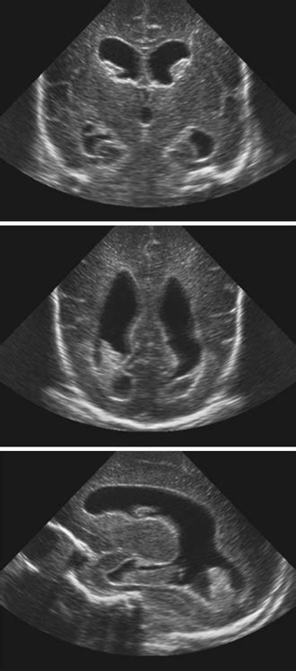 Hydrocephalus Ultrasound