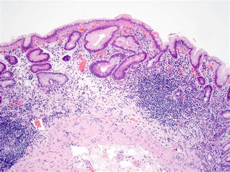 Pathology Outlines - Autoimmune gastritis