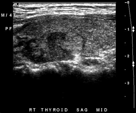 Thyroid ultrasound demonstrating a 1.4 × 1.5 × 2 cm heterogenous nodule ...