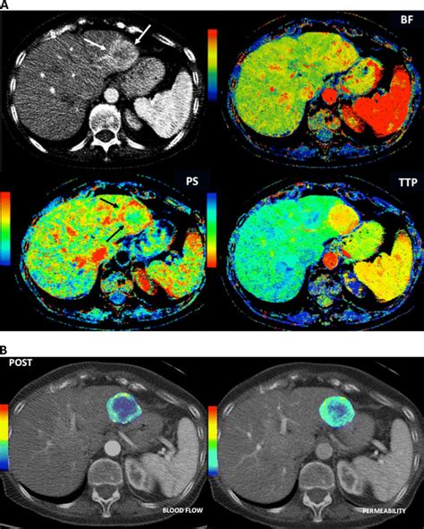 Perfusion CT images in a patient with liver metastases from a... | Download Scientific Diagram