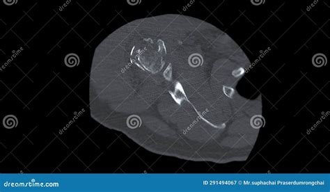 CT Scan of Shoulder Joint in Case Fracture Shoulder Joint Stock Image - Image of clavicle, joint ...