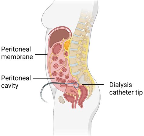 Peritoneal Dialysis — The Kidney Literacy Centre (Australia)