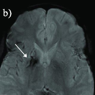 (a) Hemorrhagic basal ganglia infarct in a 16-yr-old girl not reporting ...