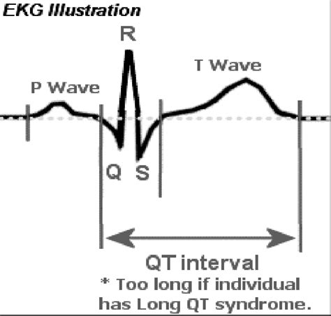 ECG illustration of measurement of a QT interval Bazett formula: QTc =... | Download Scientific ...