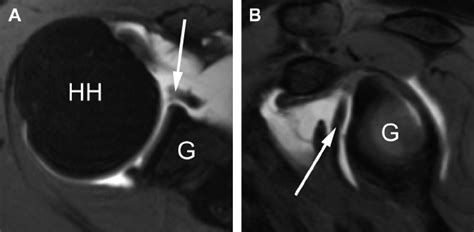 Buford complex. ( A ) Axial and ( B ) sagittal oblique T1-weighted... | Download Scientific Diagram