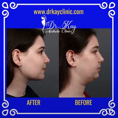 Double Chin Liposuction - Dr Kay Clinic