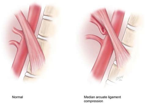 Median arcuate ligament syndrome