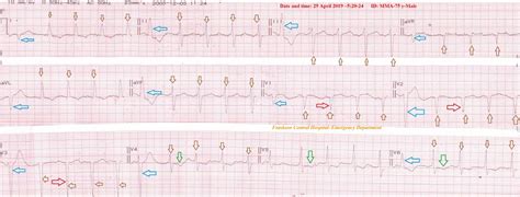 Test the Termination of Regular Ischemic Premature Ventricular Contractions Variants with Nitro ...