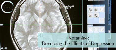 Ketamine: Reversing the Effects of Depression - Lakeside Med Spa & IV ...