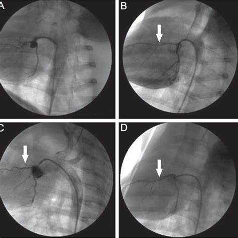 Coronary artery angiogram after left anterior descending (LAD) artery... | Download Scientific ...