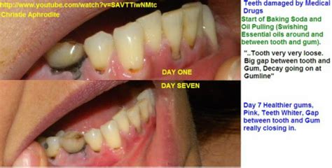 How To Regrow Teeth With Eggshells - TeethWalls