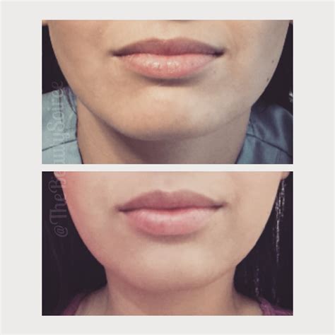 Botox for Jaw Slimming - The Skiny