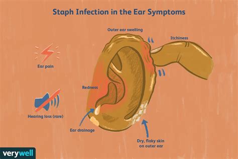 Qué causa las infecciones por estafilococos en el oído y cómo tratarlas - Medicina Básica