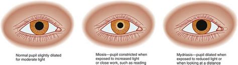 Assessment of the Eye and Vision | Nurse Key