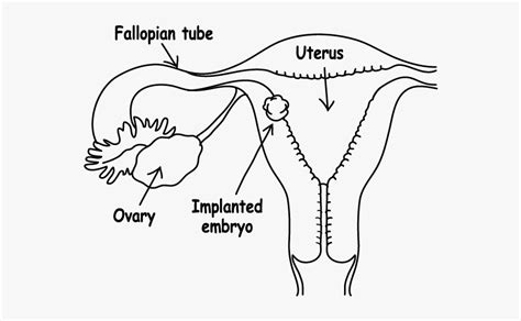 Implantation Diagram