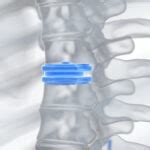 What is Artificial Disc Replacement? - Rocky Mountain Brain and Spine Institute