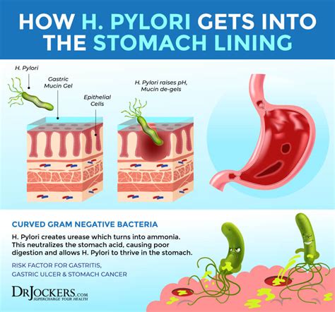 H Pylori Protocol: Diet & Herbal Strategies - DrJockers.com