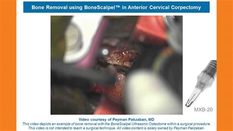 Anterior Cervical Corpectomy - YouTube