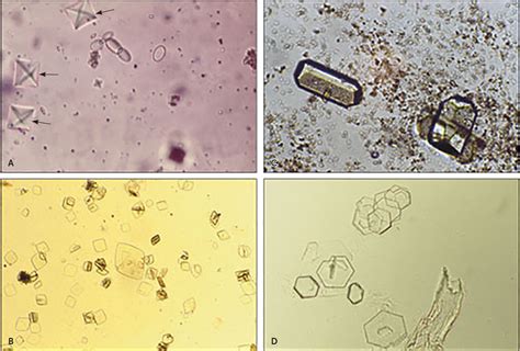 Office-Based Urinalysis: A Comprehensive Review | AAFP