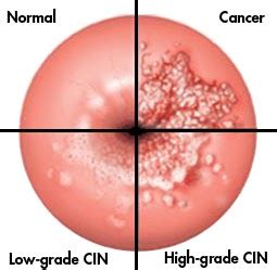 Medical Lecture Notes Online: Screening for Cervical Cancer