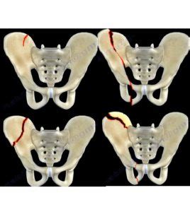 Iliac Wing Fractures — OrthopaedicPrinciples.com