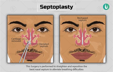 Septoplasty: Procedure, Purpose, Results, Cost, Price