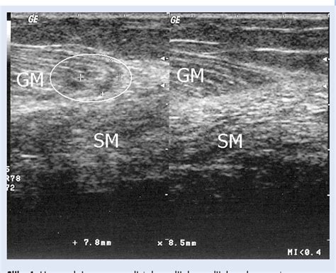 Figure 1 from Rupture of the medial gastrocnemius head (Tennis leg ...