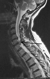 Cervical Spine Herniated Disc | Spine Specialist