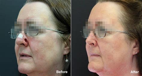 Reconstructive Surgery Photos | Princeton, NJ | Patient 9865