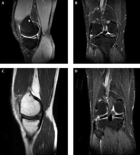 Knee Medial Meniscus Tear