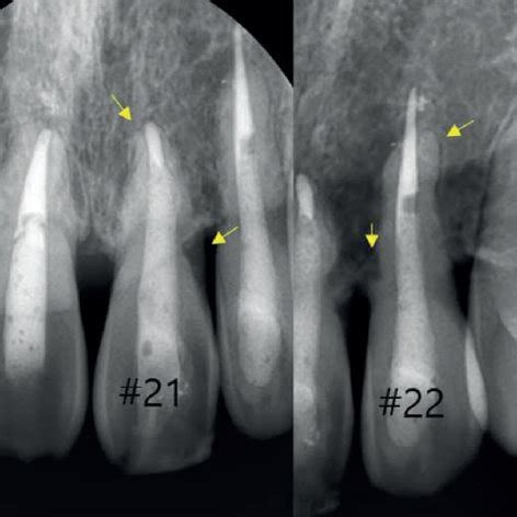 (a) Splinting of the avulsed teeth after replantation. The space around... | Download Scientific ...