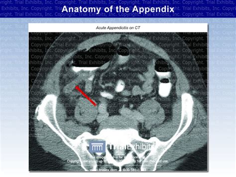 Anatomy of the Appendix: Acute Appendicitis on CT - TrialQuest In...