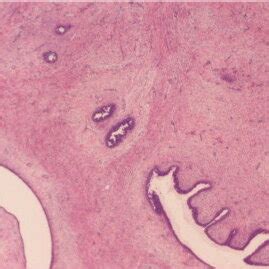 The histology of the second tumor. Benign phyllodes tumor is apparent.... | Download Scientific ...