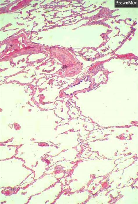 Emphysema