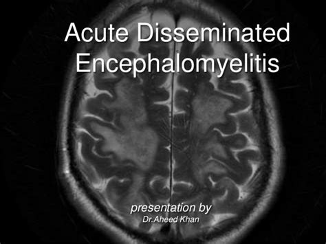 Acute Disseminated Encephalomyelitis