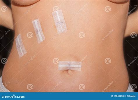 Gall Bladder Surgery stock image. Image of post, tape - 15245253