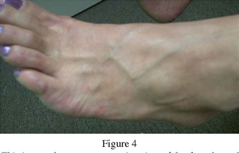 Ganglion Cyst In The Big Toe Joint [Causes, Symptoms Best, 53% OFF