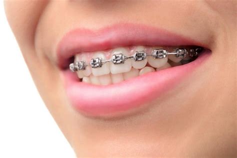 Tips to ease braces pain - Dental Services Melbourne | Cosmetic Dentist ...