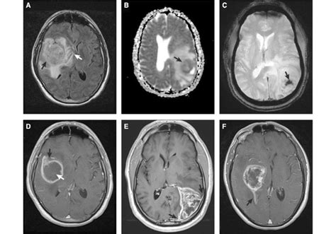 Typical MRI features of gliosarcomas. a FLAIR image demonstrating a ...