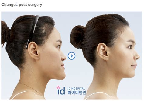 ID Hospital Korea: [class III double jaw] how much is "class iii malocclusion surgery korea at ...