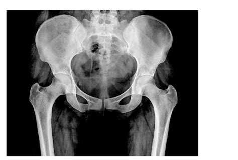 Hip Impingement Explained: Causes and Treatment - Sport Doctor London